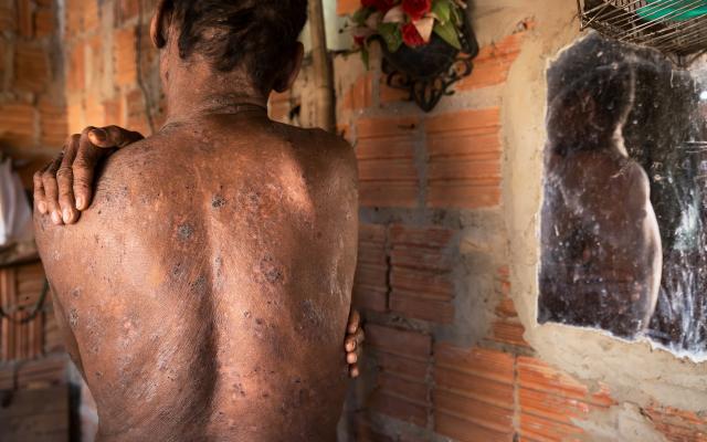 Carlos shows the skin damage he reported was caused by chemical use on fruit plantations in North-Eastern Brazil. 